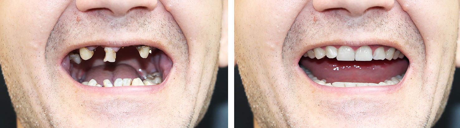 The image shows a person with two different facial expressions side by side, captured in a split-screen format, with an alt tag description that reads A man with two contrasting facial expressions, one showing teeth and the other not.