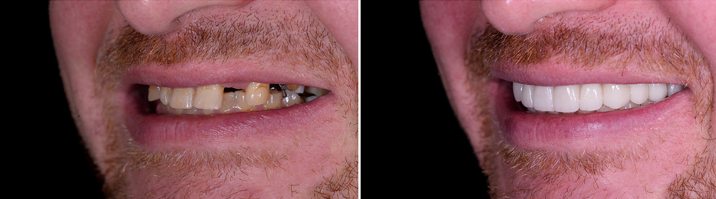 The image shows a person with two photos side by side on the left, the person s teeth are yellowed, and on the right, their teeth have been whitened.